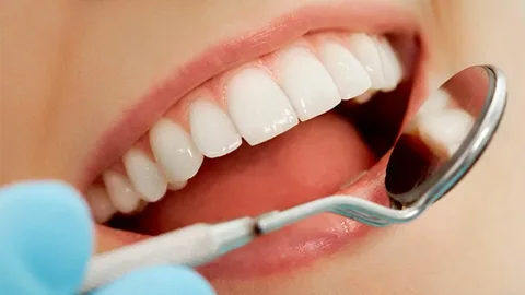 Veneers covered by insurance