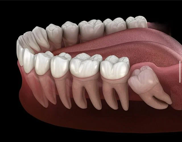 Wisdom teeth removal price without insurance