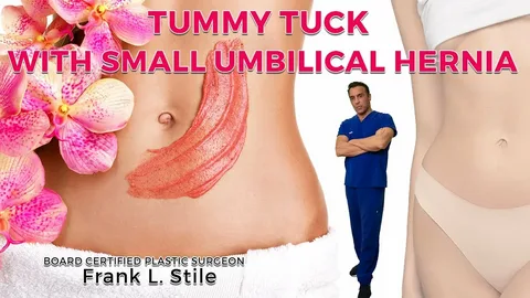 Will insurance pay for tummy tuck with hernia repair